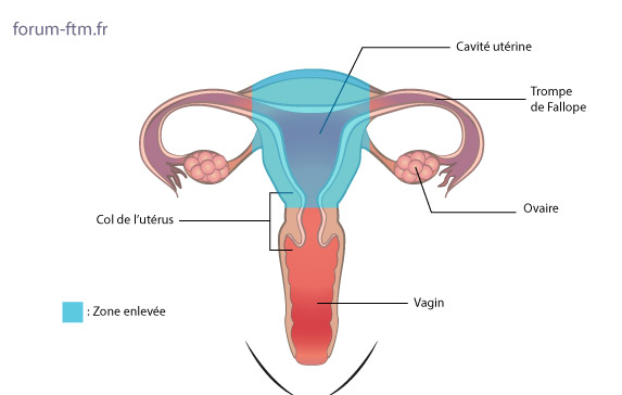 Hysterectomie-sub-totale.jpg