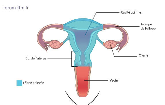 Hysterectomie-totale-sans-annexectomie.jpg