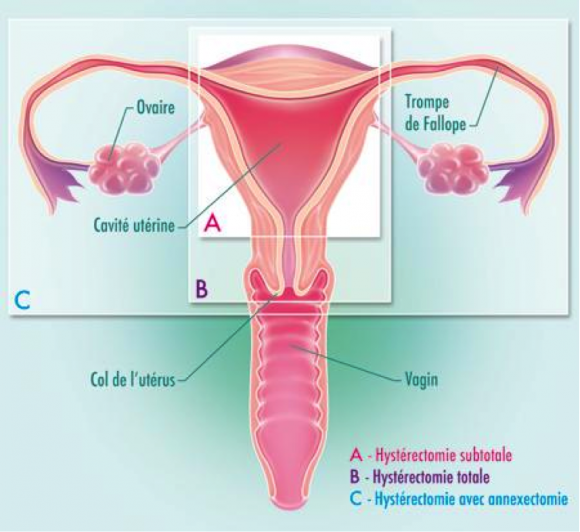 hysterectomie-580x532.png