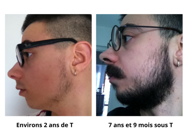 Comparaison barbe - 2 ans vs 7 ans et 9 mois de T.png
