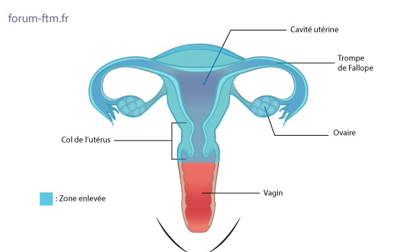 Hysterectomie-totale-avec-annexectomie.jpg